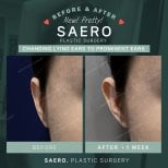 Результати отопластики в SAERO Plastic Surgery – корекція вух через 1 тиждень