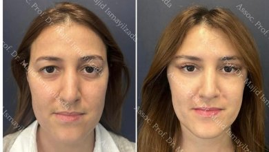before-after photo tightening-of-facial-skin-facelift