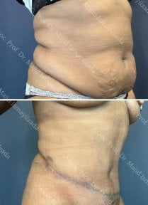 Before and after tummy tuck results at Central Hospital – improved abdominal contour