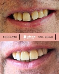 Vorher-nachher-Ergebnis Zahnkronen bei Clínica Dental Raíces, verbesserte Zahnästhetik