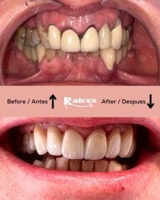 Vorher-nachher-Ergebnis Zahnkronen bei Clínica Dental Raíces, verbesserte Zahnästhetik