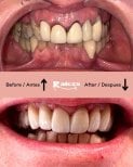 Vorher-nachher-Ergebnis Zahnkronen bei Clínica Dental Raíces, verbesserte Zahnästhetik