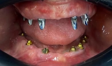 before-after photo dental-implant
