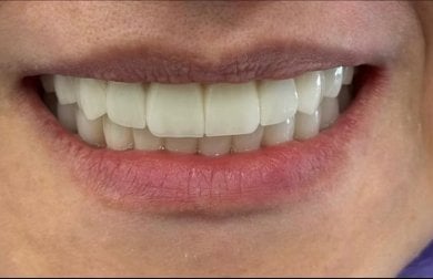 before-after photo dental-implant