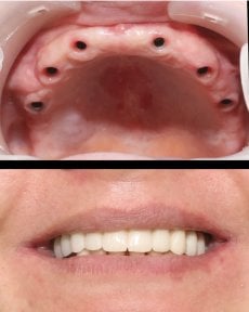 before-after photo dental-implant