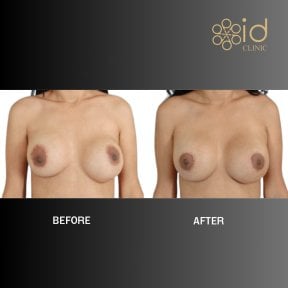 before-after photo breast-augmentation