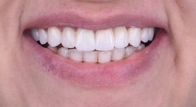 before-after photo dental-implant