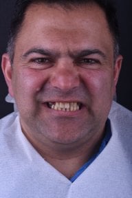 before-after photo dental-implant