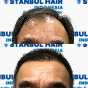 Résultats avant et après greffe de cheveux FUE à Istanbul Hair Indonesia, ligne restaurée