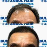 Résultats avant et après greffe de cheveux FUE à Istanbul Hair Indonesia, ligne restaurée