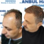 Résultat avant et après greffe de cheveux DHI chez Istanbul Hair Indonesia, ligne restaurée