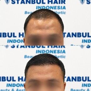 Résultats avant et après greffe DHI chez Istanbul Hair Indonesia, ligne capillaire améliorée