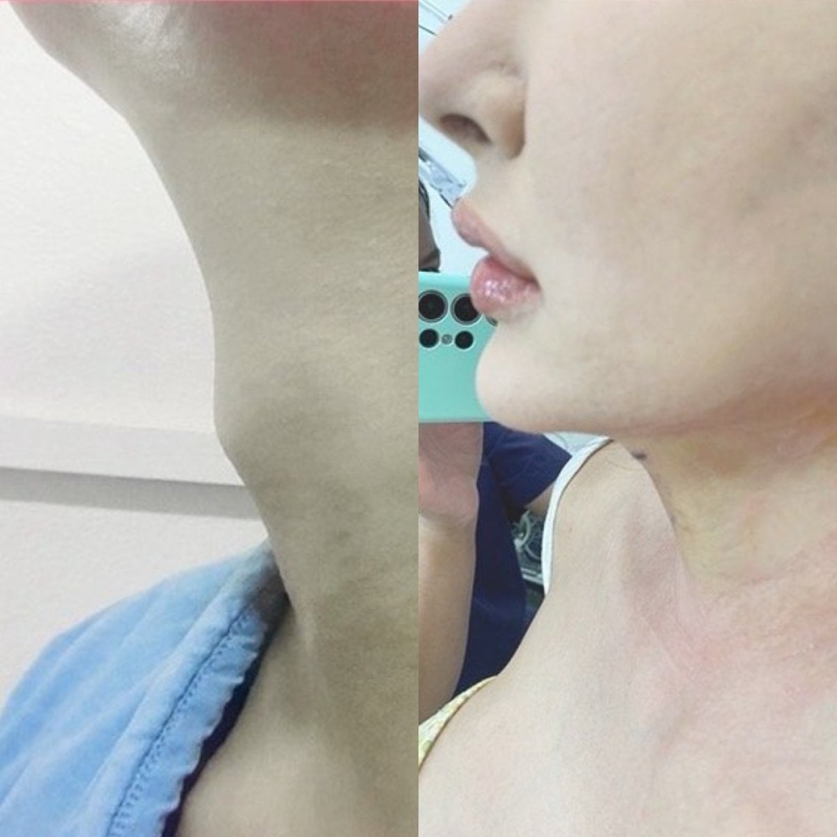 Resultados antes y después de afeitado traqueal en Somchai Clinic – menor prominencia laríngea