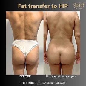 before-after photo 360-liposuction
