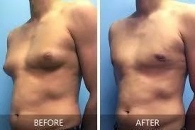 before-after photo 360-liposuction