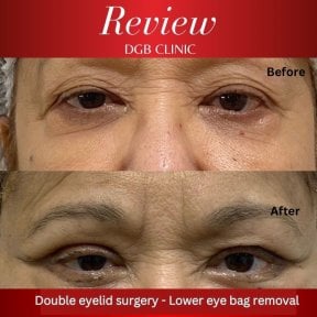 Résultats de blépharoplastie inférieure à la DGB Clinic, poches sous les yeux réduites