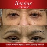 Résultats de blépharoplastie inférieure à la DGB Clinic, poches sous les yeux réduites
