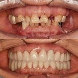 Resultados antes y después de implantes dentales en 365 Seoul OneTop Dental Clinic, sonrisa restaurada