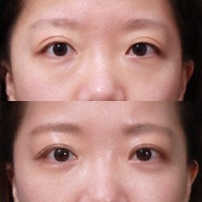 Before and after lower eyelid blepharoplasty results at VG Plastic Surgery, refreshed eye area