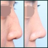 Before and after nasal hump removal results at SAERO Plastic Surgery, smoother nose profile