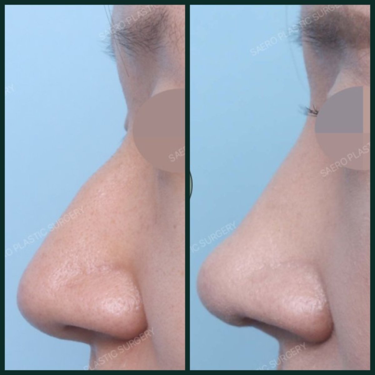 نتائج قبل وبعد إزالة حدبة الأنف في SAERO Plastic Surgery، مظهر أنف أكثر نعومة