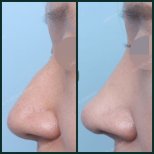 Résultats avant et après retrait de bosse nasale chez SAERO Plastic Surgery, profil lissé