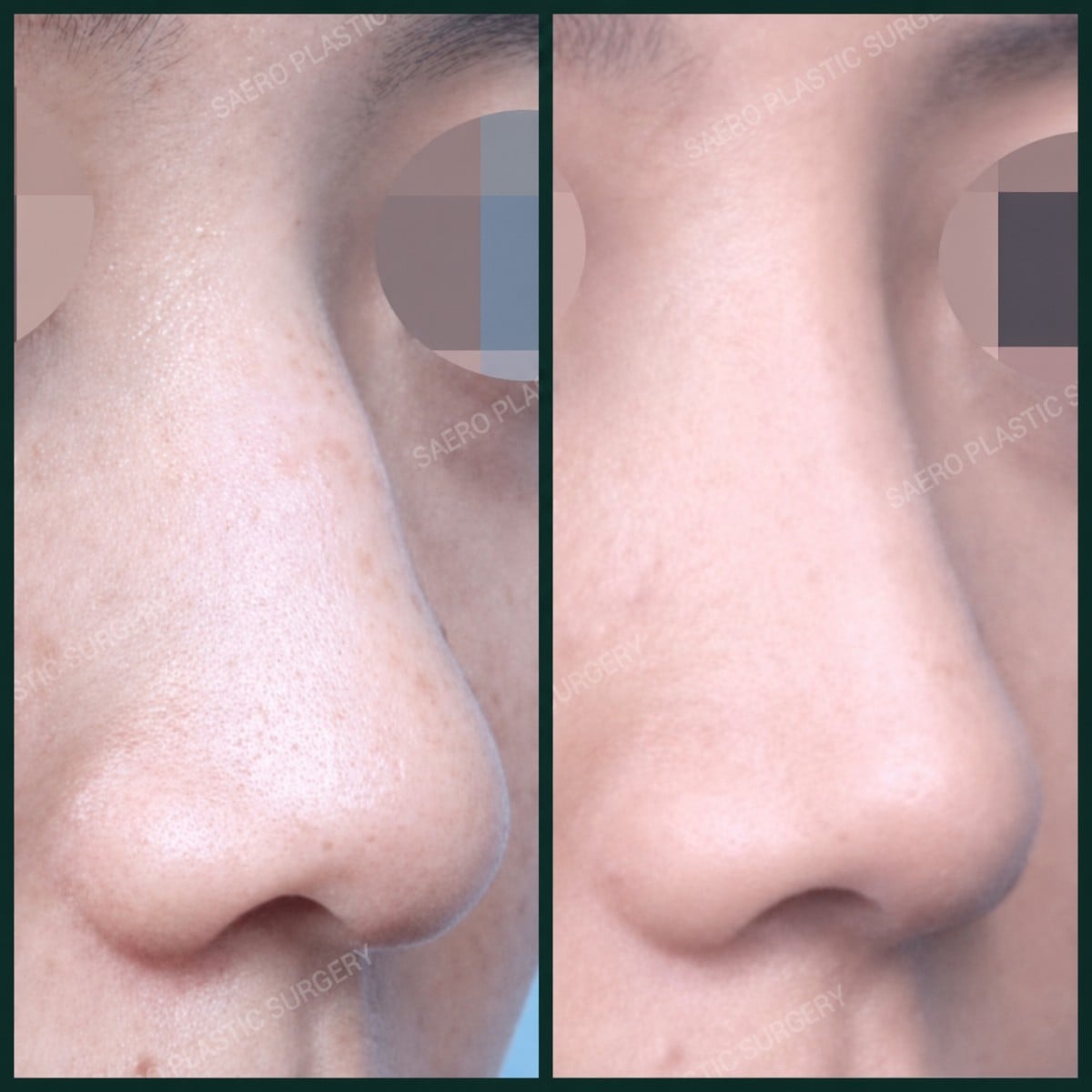 نتائج قبل وبعد إزالة حدبة الأنف في SAERO Plastic Surgery، مظهر أنف أكثر نعومة