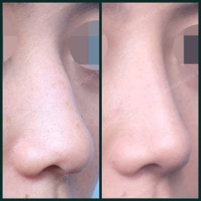 Результаты до и после удаления горбинки носа в SAERO Plastic Surgery, ровный профиль