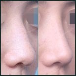 Результаты до и после удаления горбинки носа в SAERO Plastic Surgery, ровный профиль