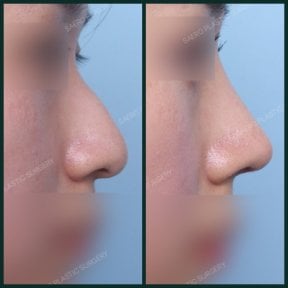 Résultats avant/après retrait de bosse nasale chez SAERO Plastic Surgery, profil amélioré
