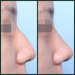 До и после удаления горбинки носа в SAERO Plastic Surgery, результат ринопластики сбоку