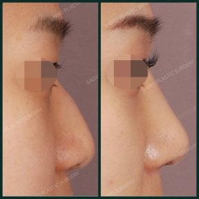قبل وبعد إزالة حدبة الأنف في SAERO Plastic Surgery، نتيجة أنف أكثر نعومة