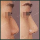 قبل وبعد إزالة حدبة الأنف في SAERO Plastic Surgery، نتيجة أنف أكثر نعومة