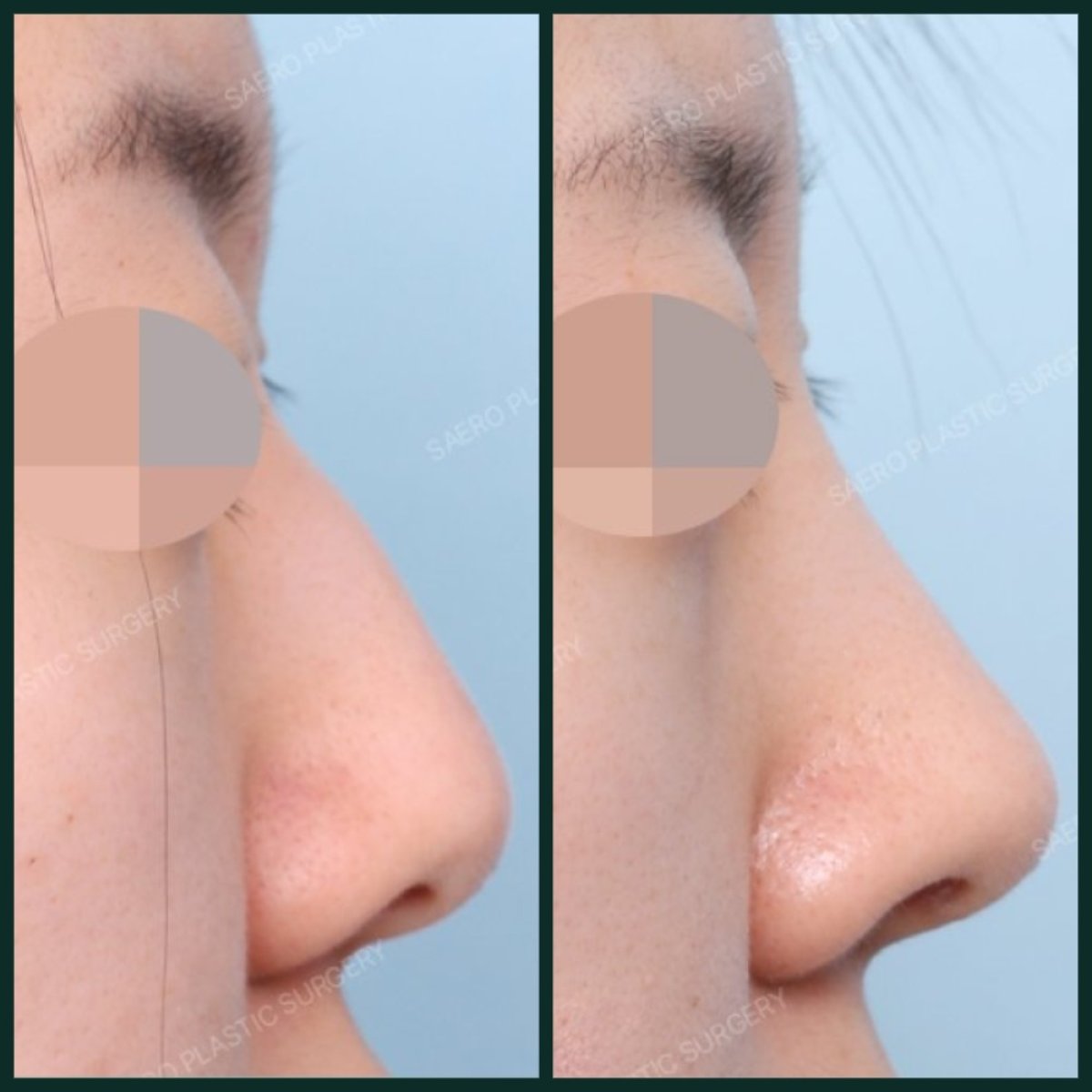 Resultados antes y después de eliminación de giba nasal en SAERO Plastic Surgery, perfil suave