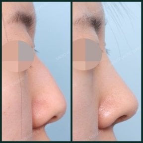 Résultats avant/après retrait de bosse nasale chez SAERO Plastic Surgery, profil lissé