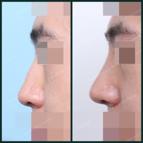Результаты до и после удаления горбинки носа в SAERO Plastic Surgery, улучшенный профиль