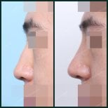 Результаты до и после удаления горбинки носа в SAERO Plastic Surgery, улучшенный профиль