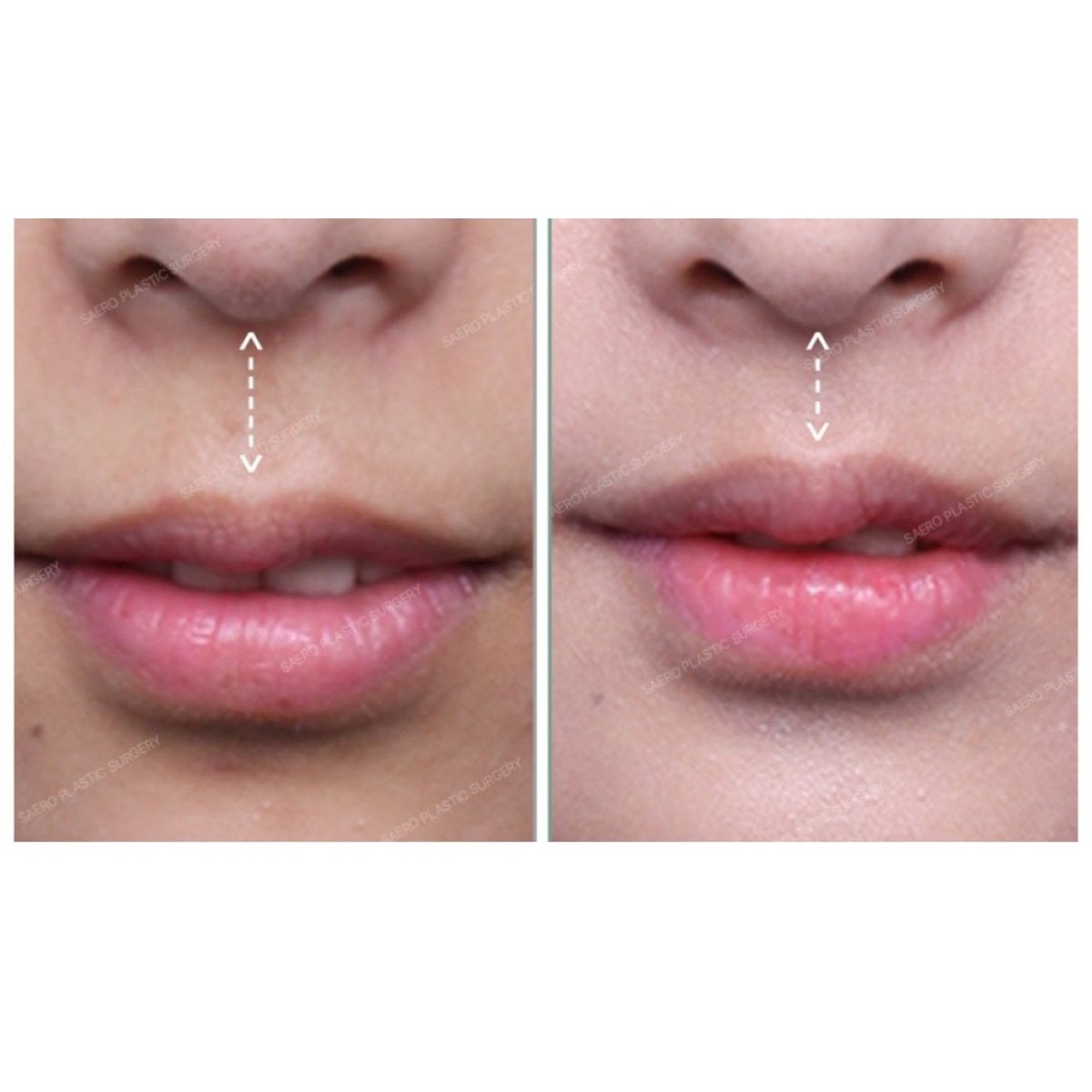 نتائج رفع الشفاه قبل وبعد في SAERO Plastic Surgery – تحسين شكل الشفة العليا