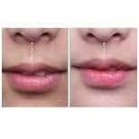 Результати до і після ліп ліфтингу в SAERO Plastic Surgery – покращений контур губ