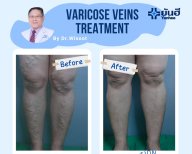 Результаты до и после лечения варикозных вен в Yanhee International Hospital, улучшение ног