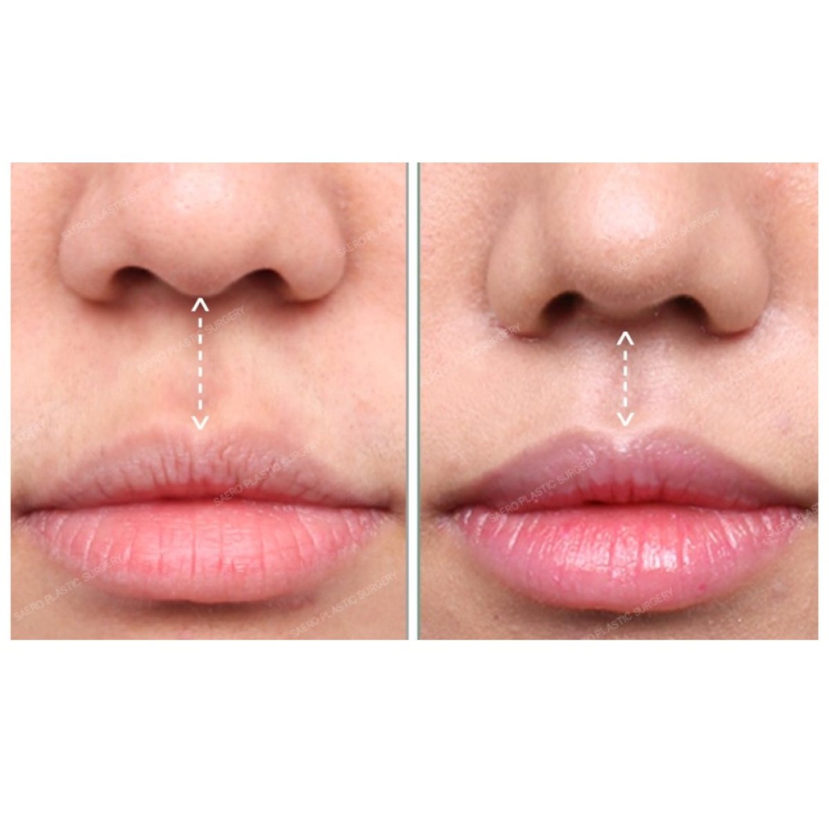 نتائج قبل وبعد رفع الشفاه في SAERO Plastic Surgery، تحسين شكل الشفة العليا