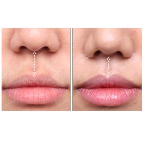 Результати до і після лип ліфтингу в SAERO Plastic Surgery, покращений контур губ