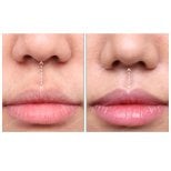 Результати до і після лип ліфтингу в SAERO Plastic Surgery, покращений контур губ