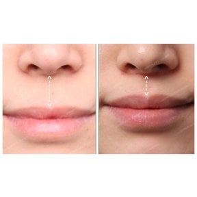 Результати до і після ліп ліфтингу в SAERO Plastic Surgery, покращений контур губ