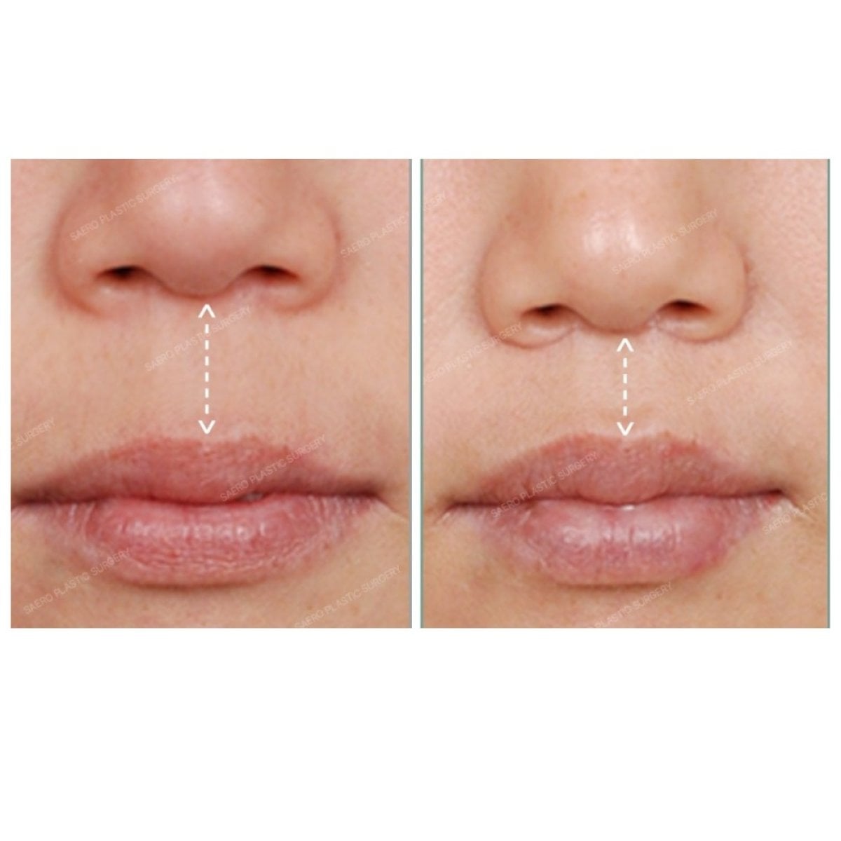 Resultados antes y después de lip lift en SAERO Plastic Surgery, contorno labial mejorado