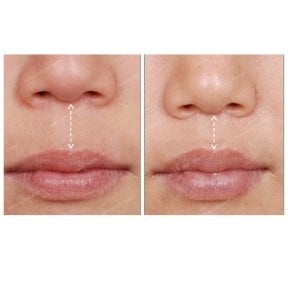 Résultats avant/après lip lift chez SAERO Plastic Surgery, contour des lèvres amélioré