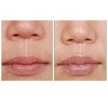 Résultats avant/après lip lift chez SAERO Plastic Surgery, contour des lèvres amélioré