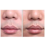Результати до і після ліфтингу губ у SAERO Plastic Surgery, покращений контур губ