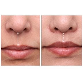 Résultats avant/après lip lift chez SAERO Plastic Surgery – contour de la lèvre supérieure amélioré