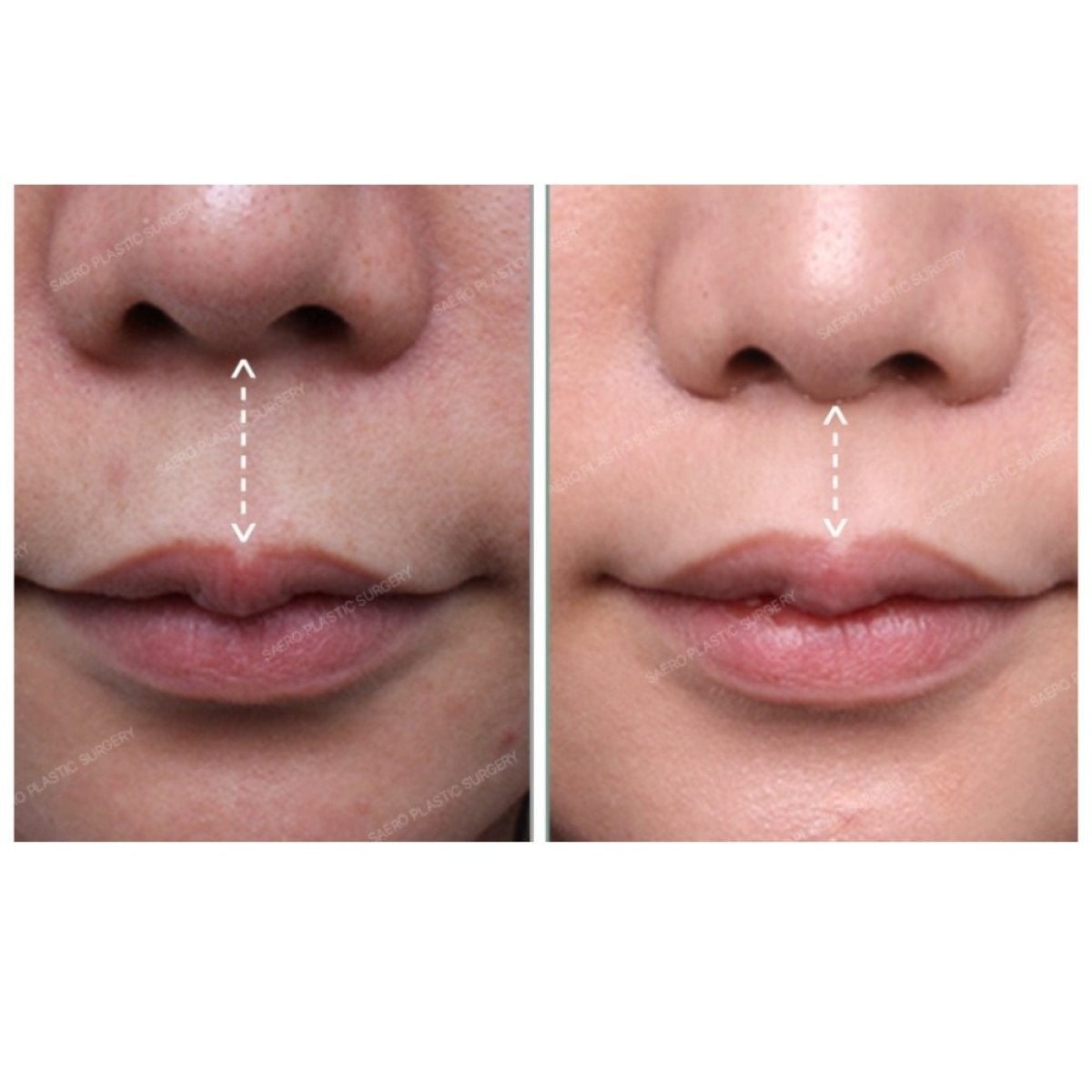 نتائج رفع الشفاه قبل وبعد في SAERO Plastic Surgery، تحسين شكل الشفة العليا